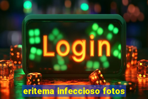 eritema infeccioso fotos
